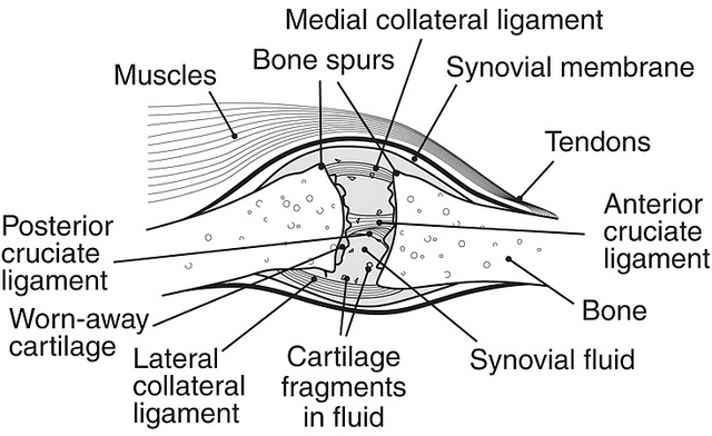 159 - Massage Therapy for Relief of Osteoarthritis